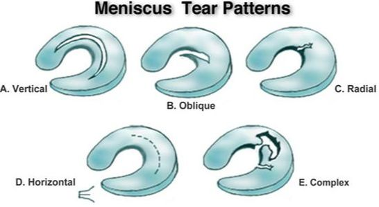 tear patterns